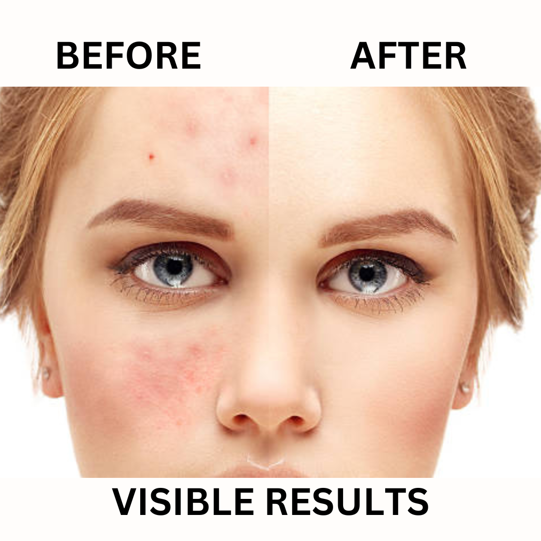 ANTI ACNE BUNDLE